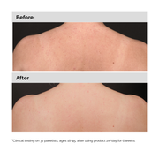 Salicylic Acid 0.5% Body Serum