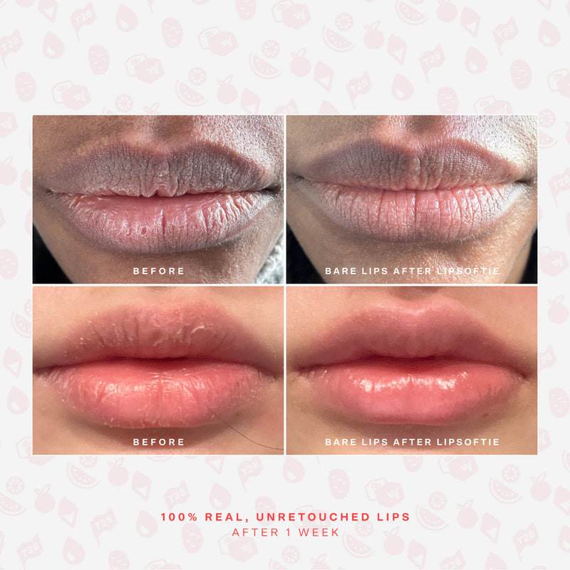 LipSoftie® Lip Treatment Set